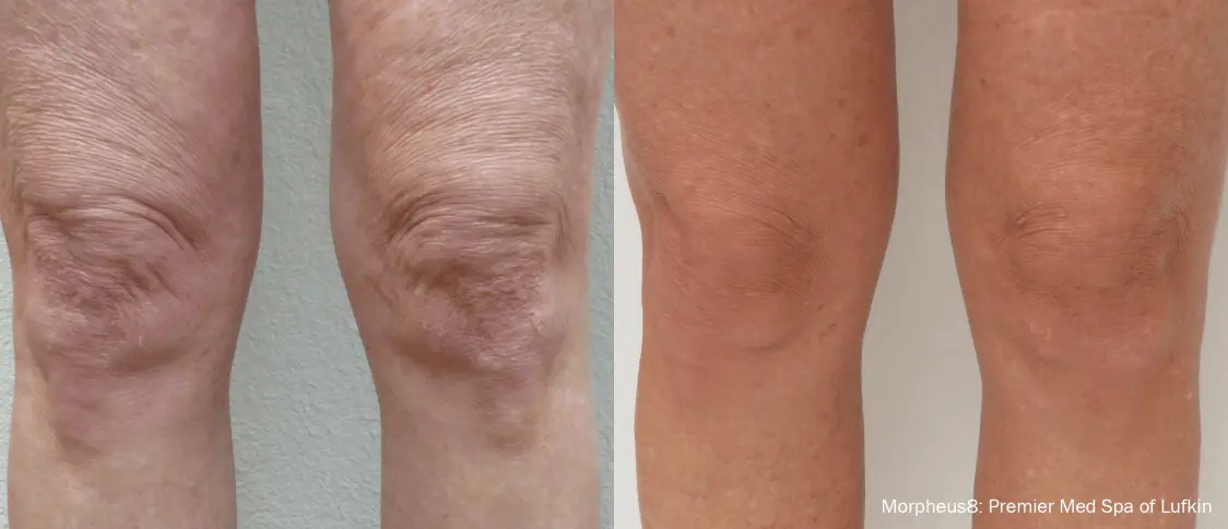 Skin Transformation with Morpheus Treatment around knee
