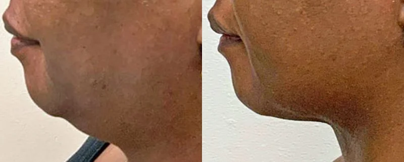 Morpheus8 before and after on the chin