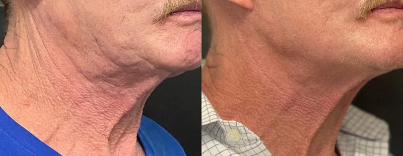 Morpheus8 before and after on the neck
