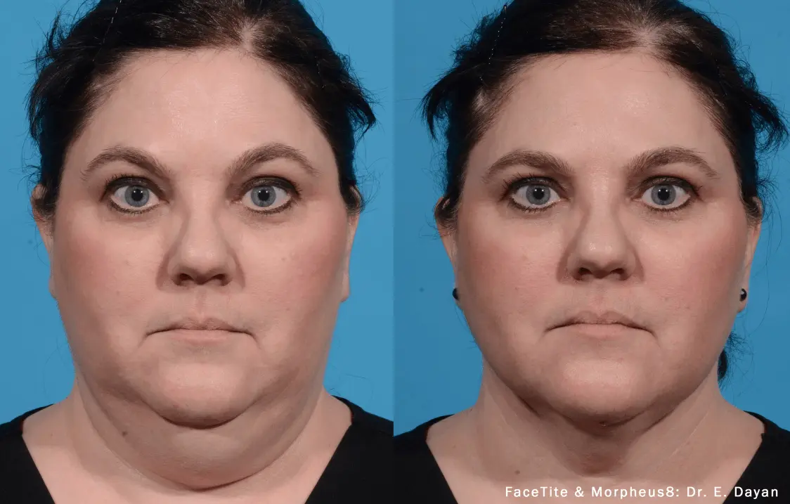 Visible improvements in skin texture and tone around the eyes 