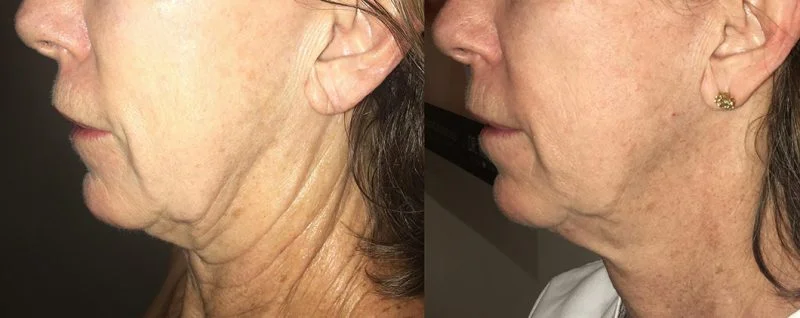 Before and after treating chin with morpheus8 for chin