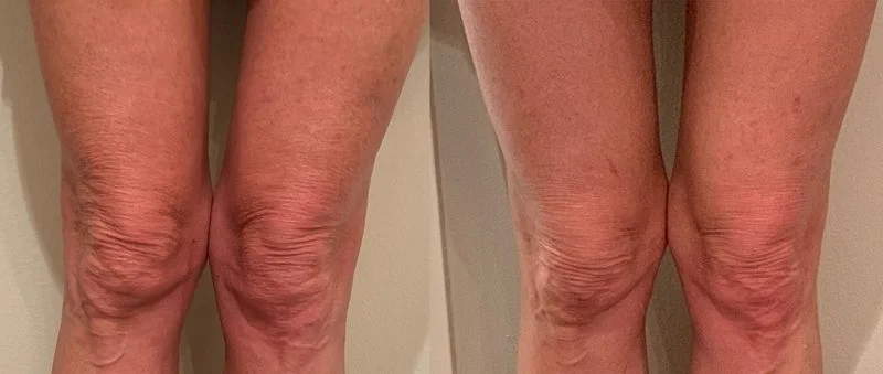 Morpheus8 before and after: knees