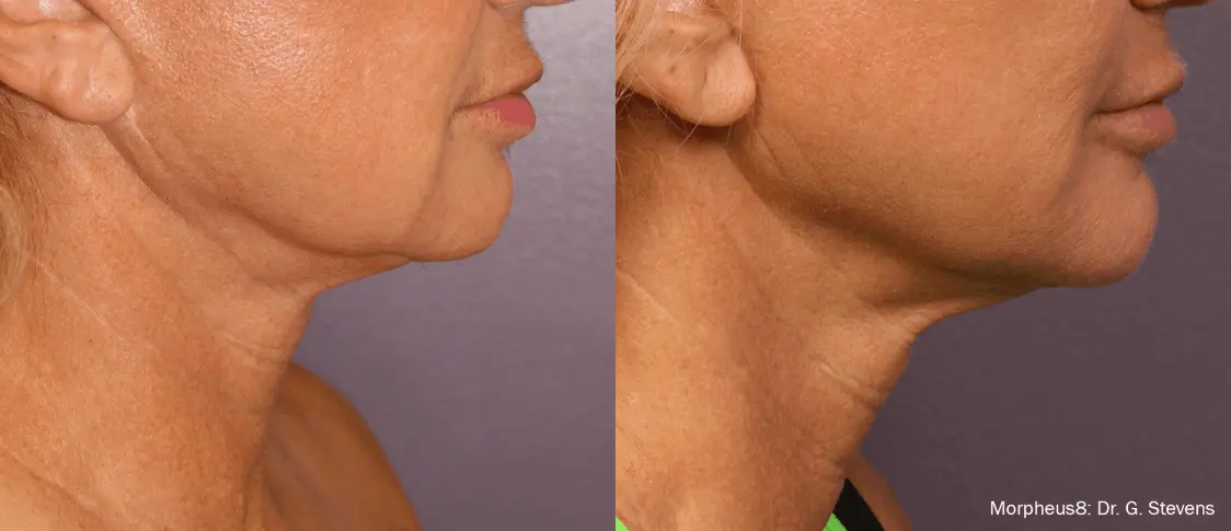 Remarkable face transformation achieved with Morpheus8