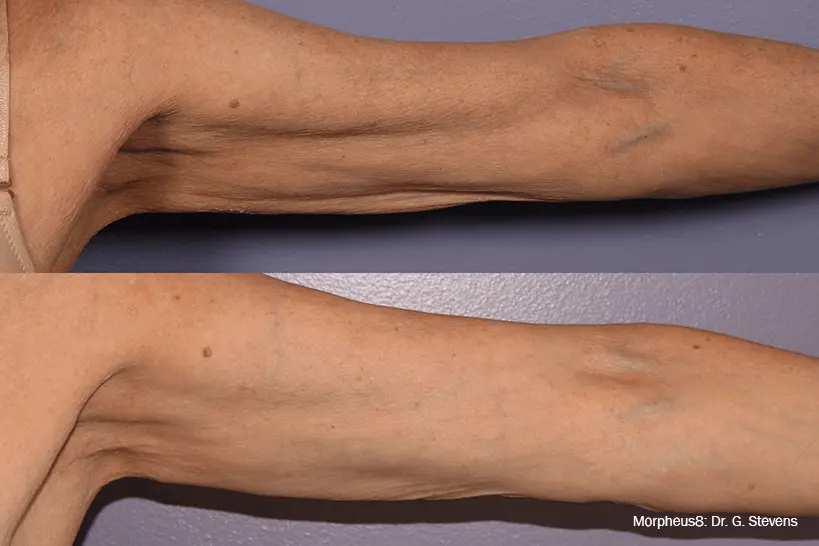 Befor & After of skin tightening with Morpheus8