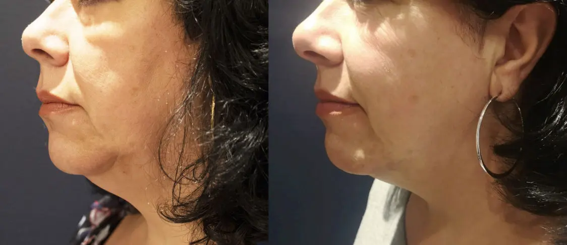 Chin Treatment Before vs. After