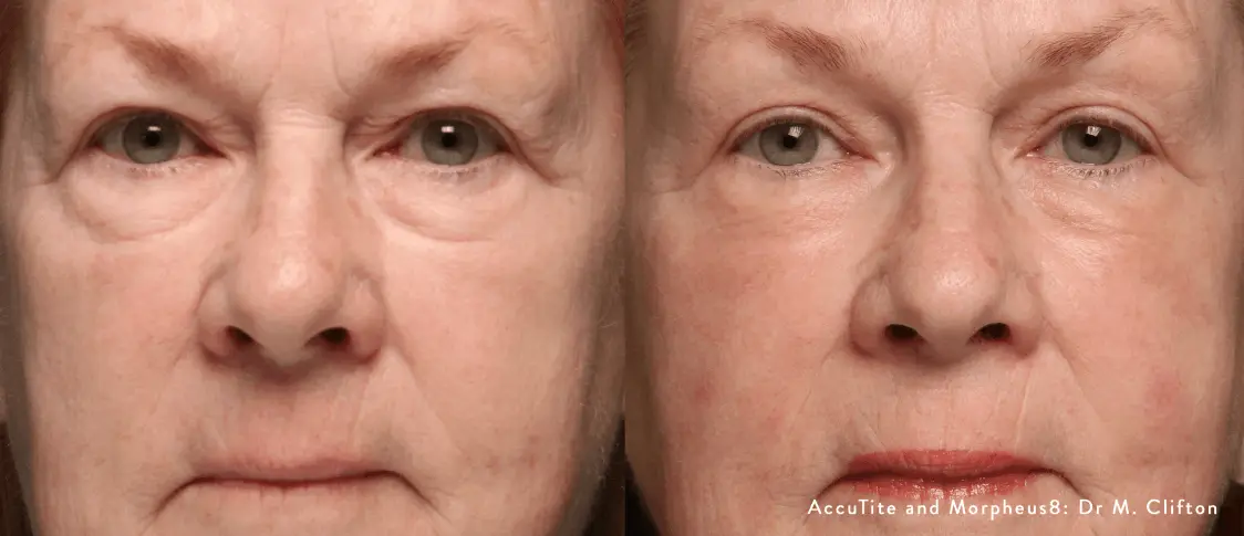 Before and after comparison of Morpheus8 around-eye treatment results