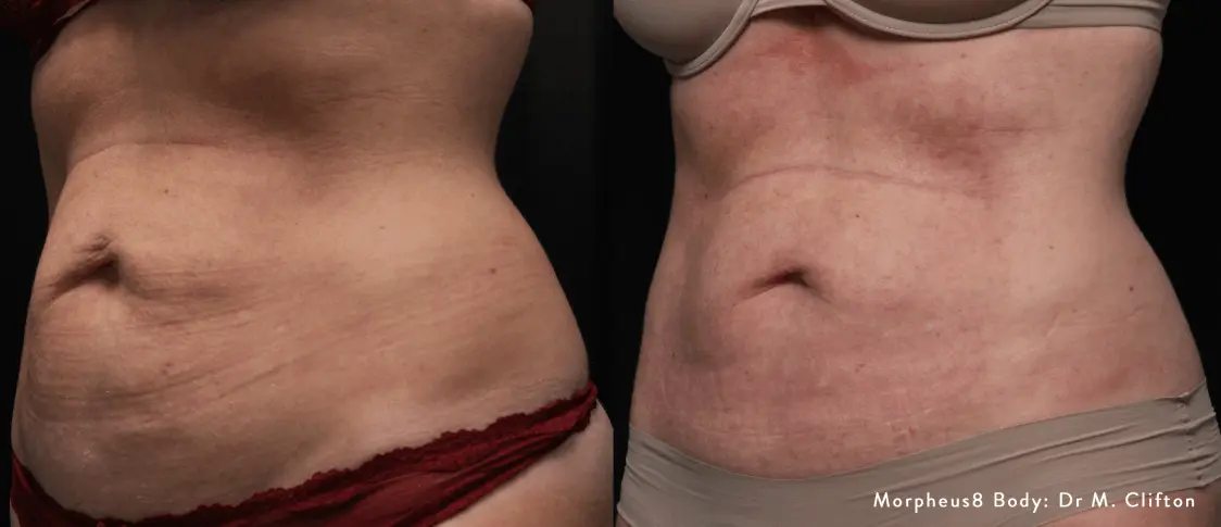 Before and after comparison of Morpheus8 tummy treatment results Builder