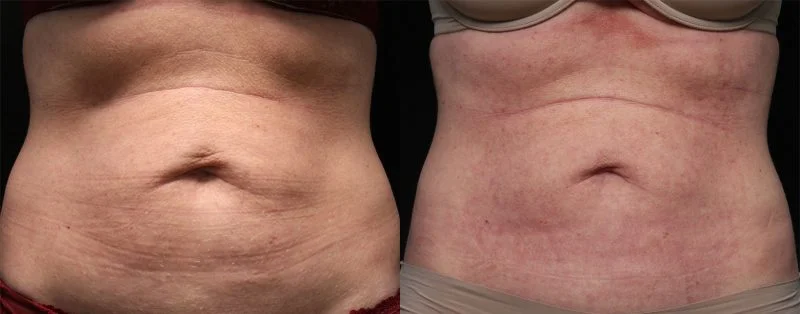 Morpheus8 before and after on the abdomen