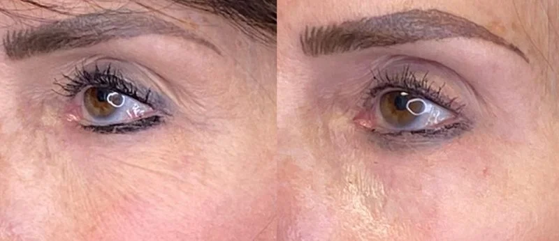 Morpheus8 before and after on the eyes